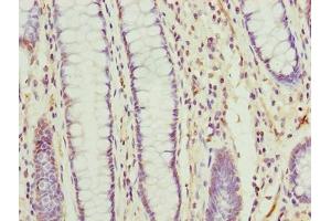Immunohistochemistry of paraffin-embedded human colon cancer using ABIN7173103 at dilution of 1:100 (TMEM177 Antikörper  (AA 219-311))