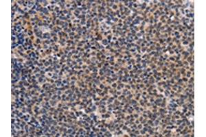 The image on the left is immunohistochemistry of paraffin-embedded Human Lymphoma tissue using ABIN7191963(POU4F1 Antibody) at dilution 1/25, on the right is treated with synthetic peptide. (POU4F1 Antikörper)