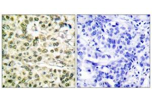 Immunohistochemical analysis of paraffin-embedded human breast carcinoma tissue, using PCNA antibody (ABIN5976487). (PCNA Antikörper  (Internal Region))