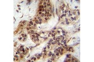 FOXA2 antibody immunohistochemistry analysis in formalin fixed and paraffin embedded human bladder carcinoma. (FOXA2 Antikörper  (AA 134-163))