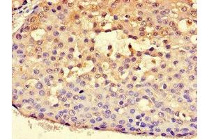 Immunohistochemistry of paraffin-embedded human breast cancer using ABIN7170815 at dilution of 1:100 (HSPA9 Antikörper  (AA 458-679))