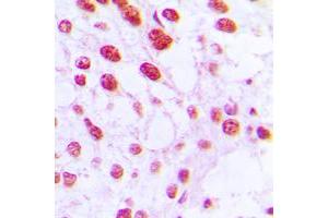 Immunohistochemical analysis of DNA Polymerase beta staining in human breast cancer formalin fixed paraffin embedded tissue section. (POLB Antikörper  (C-Term))
