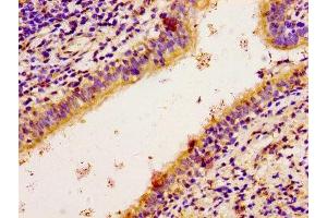 Immunohistochemistry of paraffin-embedded human lung cancer using ABIN7168176 at dilution of 1:100 (RPS6KA2 Antikörper  (AA 228-395))