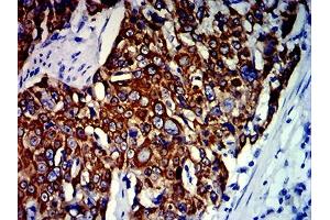 Immunohistochemical analysis of paraffin-embedded esophageal cancer tissues using KRT13 mouse mAb with DAB staining. (Cytokeratin 13 Antikörper  (AA 104-458))