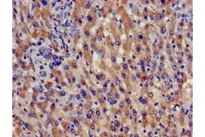 Immunohistochemistry of paraffin-embedded human liver cancer using ABIN7159025 at dilution of 1:100 (SPG21 Antikörper  (AA 1-308))