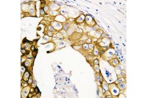 Anti-Cytokeratin 19 antibody, IHC(P) IHC(P): Human Oesophagus Squama Cancer Tissue