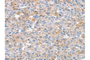 The image on the left is immunohistochemistry of paraffin-embedded Human liver cancer tissue using ABIN7192585(SNX25 Antibody) at dilution 1/35, on the right is treated with synthetic peptide.