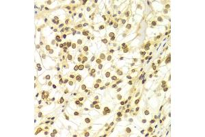 Immunohistochemistry of paraffin-embedded Human kidney cancer using Lamin A/C antibody (ABIN5970079) at dilution of 1/100 (40x lens). (Lamin A/C Antikörper)