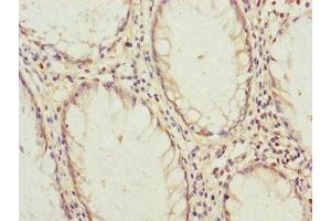 Immunohistochemistry of paraffin-embedded human colon cancer using ABIN7145189 at dilution of 1:100 (B9D2 Antikörper  (AA 1-175))