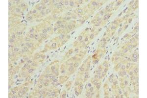 Immunohistochemistry of paraffin-embedded human liver cancer using ABIN7159907 at dilution of 1:100 (TIMM8A/DDP Antikörper  (AA 1-97))
