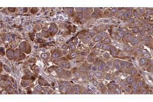 ABIN6273841 at 1/100 staining Human liver cancer tissue by IHC-P. (CCR2 Antikörper  (Internal Region))