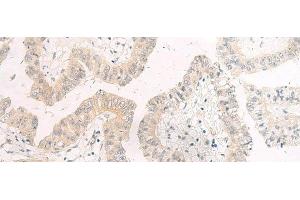Immunohistochemistry of paraffin-embedded Human liver cancer tissue using HASPIN Polyclonal Antibody at dilution of 1:45(x200) (GSG2 Antikörper)