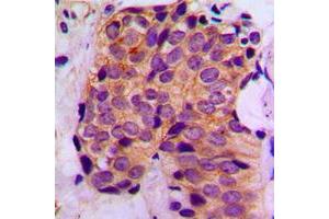 Immunohistochemical analysis of MAGEA1 staining in human breast cancer formalin fixed paraffin embedded tissue section. (MAGEA1 Antikörper  (C-Term))