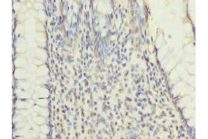 Immunohistochemistry of paraffin-embedded human colon cancer using ABIN7151184 at dilution of 1:100