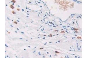 Detection of CEACAM7 in Human Colorectal cancer Tissue using Polyclonal Antibody to Carcinoembryonic Antigen Related Cell Adhesion Molecule 7 (CEACAM7) (CEACAM7 Antikörper  (AA 147-231))