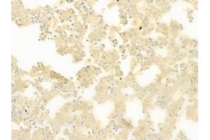 ABIN6259921 and ABIN6277899 at 1/100 staining human melanoma by IHC-P. (Amylin/DAP Antikörper  (Internal Region))