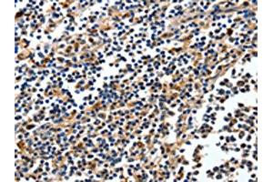 The image on the left is immunohistochemistry of paraffin-embedded Human tonsil tissue using ABIN7130415(NFKBID Antibody) at dilution 1/25, on the right is treated with fusion protein.