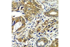 Immunohistochemistry of paraffin-embedded human gastric cancer using CDC16 antibody  at dilution of 1:100 (40x lens). (CDC16 Antikörper  (AA 371-620))