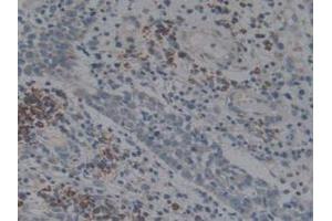 IHC-P analysis of Human Skin Cancer Tissue, with DAB staining. (Angiotensin I Converting Enzyme 1 Antikörper  (AA 1160-1306))
