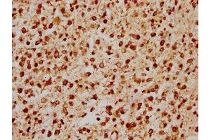 IHC image of ABIN7153409 diluted at 1:200 and staining in paraffin-embedded human glioma performed on a Leica BondTM system. (GABPA Antikörper  (AA 268-372))
