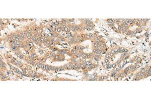 Immunohistochemistry of paraffin-embedded Human liver cancer tissue using CPNE4 Polyclonal Antibody at dilution of 1:40(x200) (Copine IV Antikörper)