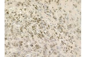 ABIN6258406 and ABIN6275684 at 1/100 staining human melanoma by IHC-P. (ZBTB40 Antikörper  (Internal Region))