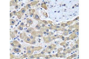 Immunohistochemistry of paraffin-embedded Human liver cancer using GFM1 Polyclonal Antibody at dilution of 1:100 (40x lens). (GFM1 Antikörper)
