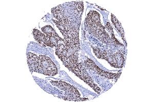Esophagus Squamous cell carcinoma with strong SOX9 immunostaining of most tumor cells (Rekombinanter SOX9 Antikörper  (AA 393-508))
