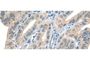 Immunohistochemistry of paraffin-embedded Human thyroid cancer tissue using CHAT Polyclonal Antibody at dilution of 1:30(x200) (Choline Acetyltransferase Antikörper)