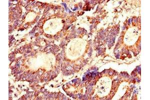Immunohistochemistry of paraffin-embedded human colon cancer using ABIN7158350 at dilution of 1:100 (LASP1 Antikörper  (AA 128-252))