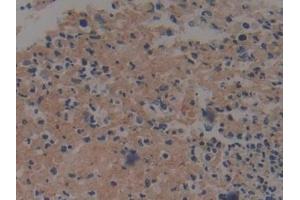 Detection of F1+2 in Human Colorectal cancer Tissue using Polyclonal Antibody to Prothrombin Fragment 1+2 (F1+2)