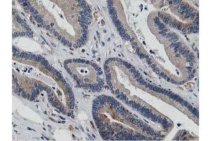 Immunohistochemical staining of paraffin-embedded Adenocarcinoma of Human colon tissue using anti-ATG3 mouse monoclonal antibody. (ATG3 Antikörper)
