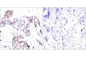 Immunohistochemistry analysis of paraffin-embedded human breast carcinoma, using Elk1 (Phospho-Ser389) Antibody. (ELK1 Antikörper  (pSer389))