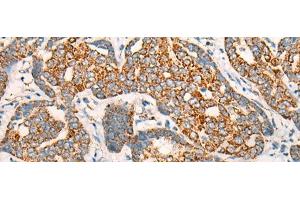 Immunohistochemistry of paraffin-embedded Human liver cancer tissue using CCT8L2 Polyclonal Antibody at dilution of 1:45(x200) (CCT8L2 Antikörper)
