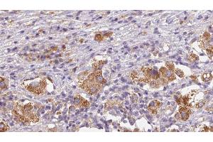 ABIN6272590 at 1/100 staining Human liver cancer tissue by IHC-P.