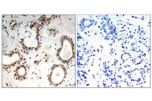 Immunohistochemical analysis of paraffin-embedded human breast carcinoma tissue, using HSF1 (Ab-307) antibody (E021206). (HSF1 Antikörper)