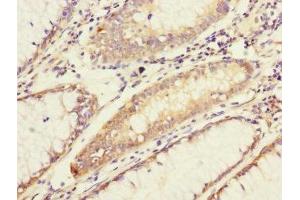 Immunohistochemistry of paraffin-embedded human colon cancer using ABIN7143328 at dilution of 1:100 (ADCY4 Antikörper  (AA 808-1077))