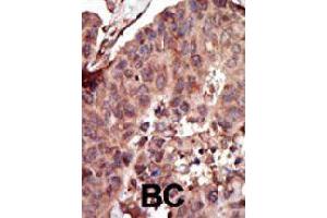 Formalin-fixed and paraffin-embedded human cancer tissue reacted with PKLR polyclonal antibody  , which was peroxidase-conjugated to the secondary antibody, followed by AEC staining . (PKLR Antikörper  (C-Term))