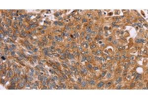 Immunohistochemistry of paraffin-embedded Human esophagus cancer tissue using PMPCB Polyclonal Antibody at dilution 1:50 (PMPCB Antikörper)