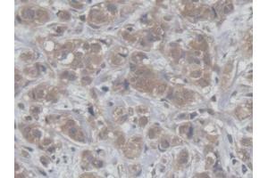 DAB staining on IHC-P; Samples: Human Breast cancer Tissue (HCFC1 Antikörper  (AA 52-258))