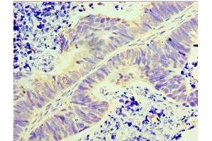 Immunohistochemistry of paraffin-embedded human ovarian cancer using ABIN7154181 at dilution of 1:100 (GLYATL1 Antikörper  (AA 1-302))