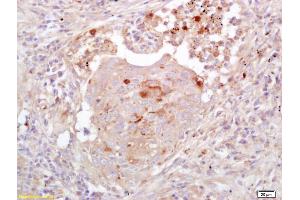 Formalin-fixed and paraffin embedded human colon carcinoma labeled with Anti-EGFL7 Polyclonal Antibody, Unconjugated (ABIN733988) at 1:200 followed by conjugation to the secondary antibody and DAB staining (EGFL7 Antikörper  (AA 30-80))