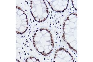 Immunohistochemistry of paraffin-embedded human colon carcinoma using MED4 Rabbit mAb (ABIN7268445) at dilution of 1:100 (40x lens). (MED4 Antikörper)