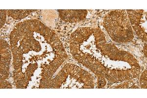 Immunohistochemistry of paraffin-embedded Human cervical cancer tissue using PDP1 Polyclonal Antibody at dilution 1:30 (PDP Antikörper)