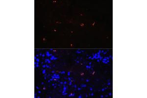 Immunofluorescence analysis of human lung cancer using Lysozyme (LYZ) (LYZ) Rabbit mAb (ABIN7268346) at dilution of 1:100 (40x lens). (LYZ Antikörper)