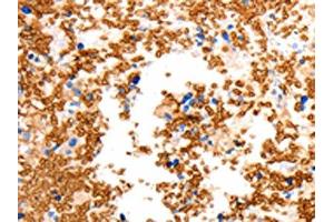 The image on the left is immunohistochemistry of paraffin-embedded Human ovarian cancer tissue using ABIN7192466(SLC2A5 Antibody) at dilution 1/12, on the right is treated with synthetic peptide. (SLC2A5 Antikörper)