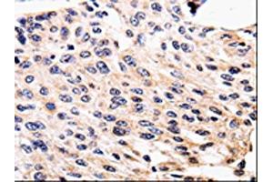 The image is immunohistochemistry of paraffin-embedded Human cervical cancer tissue using (ALK Antibody) at dilution 1/25. (ALK Antikörper)