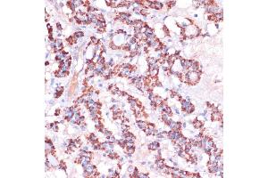 Immunohistochemistry of paraffin-embedded human thyroid cancer using MRPL23 antibody (ABIN7268564) at dilution of 1:100 (40x lens). (MRPL23 Antikörper  (AA 1-153))