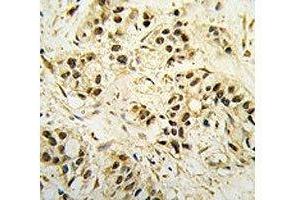 IHC analysis of FFPE human breast carcinoma tissue stained with CDC2 antibody (CDK1 Antikörper  (AA 1-30))