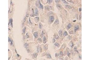 Immunohistochemical staining of formalin-fixed paraffin-embedded human lung carcinoma tissue showing cytoplasmic staining with CASP7 polyclonal antibody  at 1 : 100 dilution. (Caspase 7 Antikörper  (C-Term))